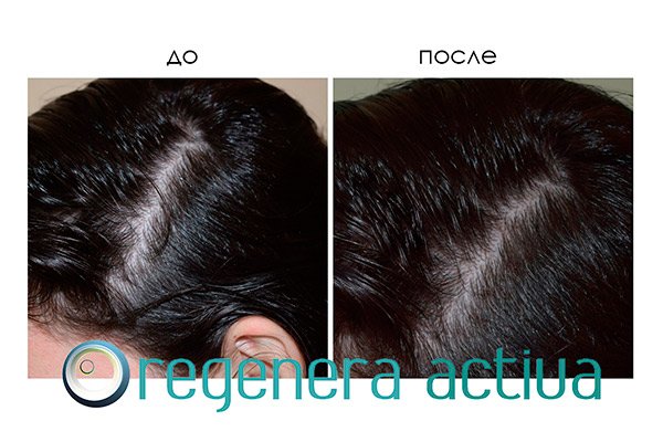 regenera-activa-result-4.jpg