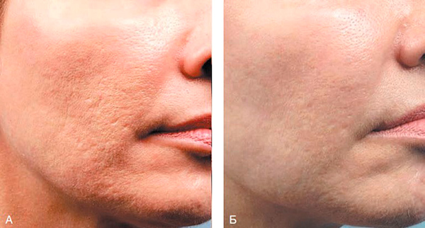 Эффект нехирургического лифтинга лица после обработки Morpheus8 нижнечелюстной линии, рубцов постакне (А) и на щеках, веках и бровях (Б).