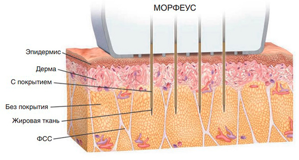 Механизм действия Morpheus8. Положительно заряженные кончики микроигл с силиконовым покрытием вводятся через кожу в поверхностную жировую ткань.